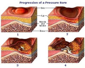 pressure ulcer
